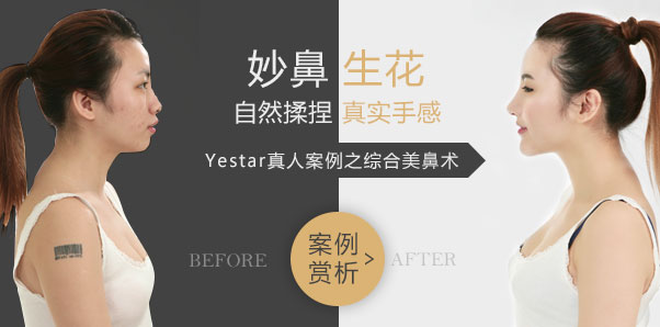 Yestar鼻部整形案例